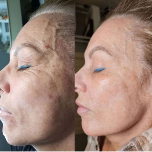 before and after spa 2