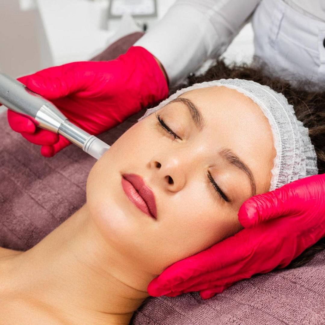 Microneedling 3