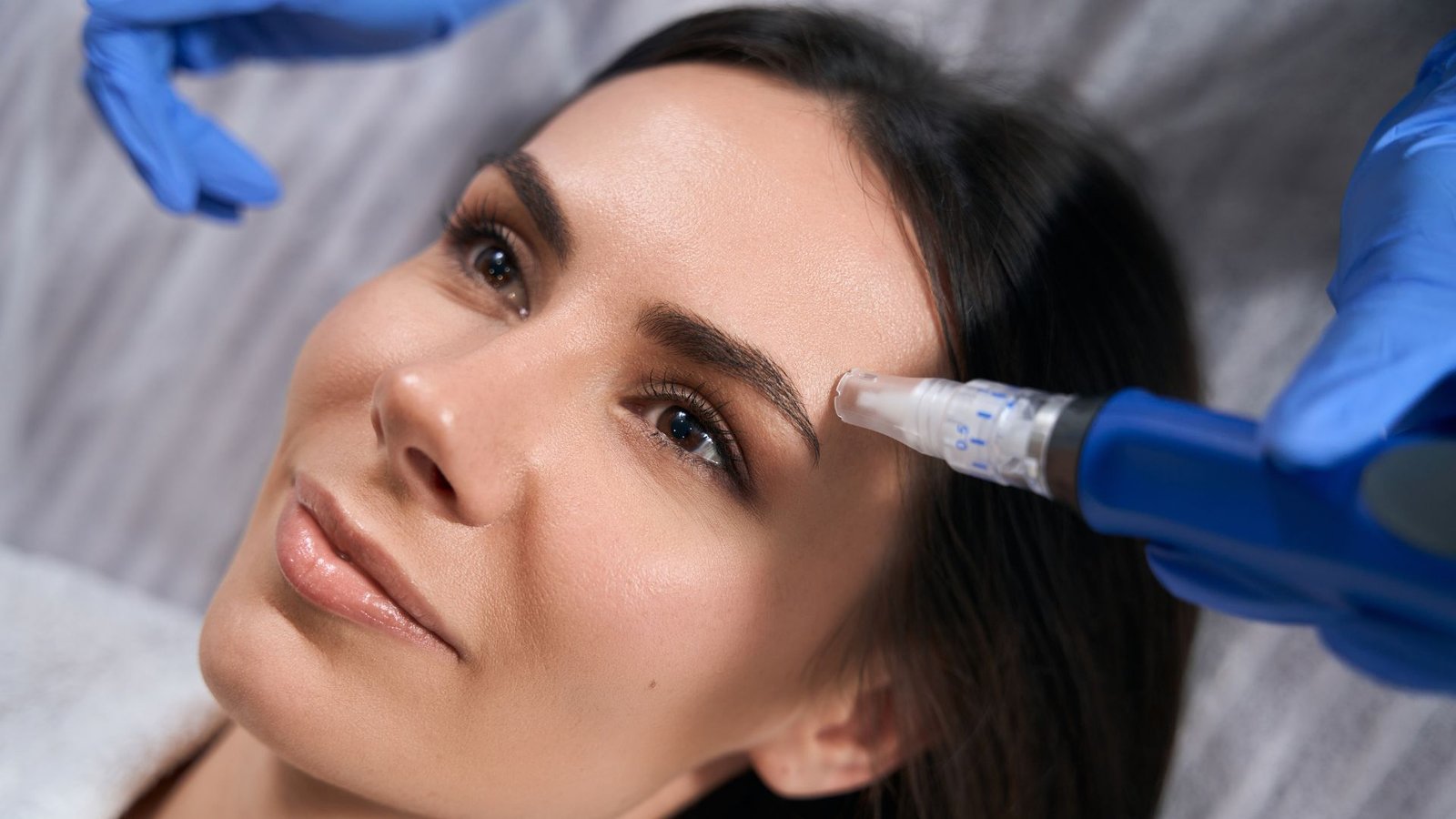 Microneedling treatments 2